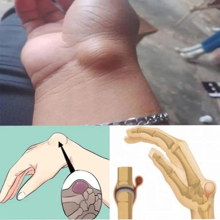 Węzły chłonne nadgarstka: przyczyny, objawy i leczenie