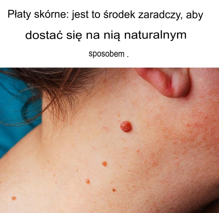 Narośla skórne: ten sposób na pozbycie się ich w sposób naturalny