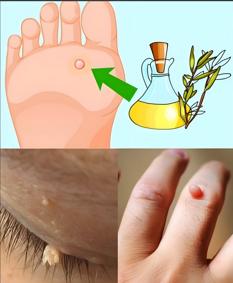 Tytuł: 8 niezwykłych korzyści z cytryny i imbiru – naturalny sposób na usuwanie narośli skórnych