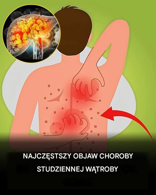 Stłuszczenie wątroby: przyczyny, objawy, leczenie