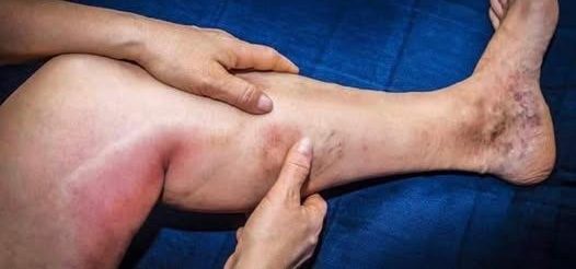 6 najlepszych naparów dla zdrowych tętnic