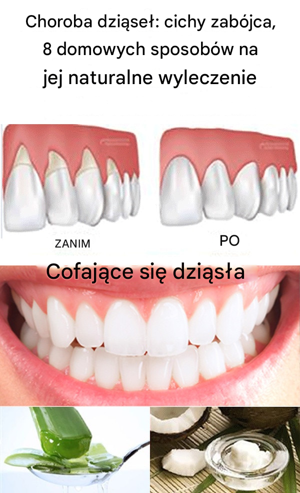 Choroba dziąseł: cichy zabójca, 8 domowych sposobów na jej naturalne wyleczenie