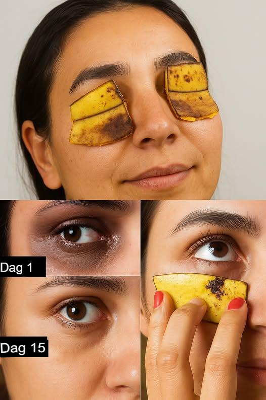 Co się stanie, jeśli będziesz trzymać skórkę od banana pod oczami przez 7 dni?