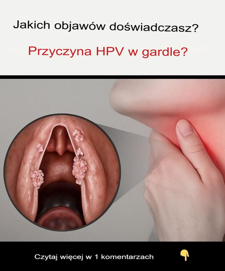 Jakie objawy w gardle wywołuje wirus HPV?
