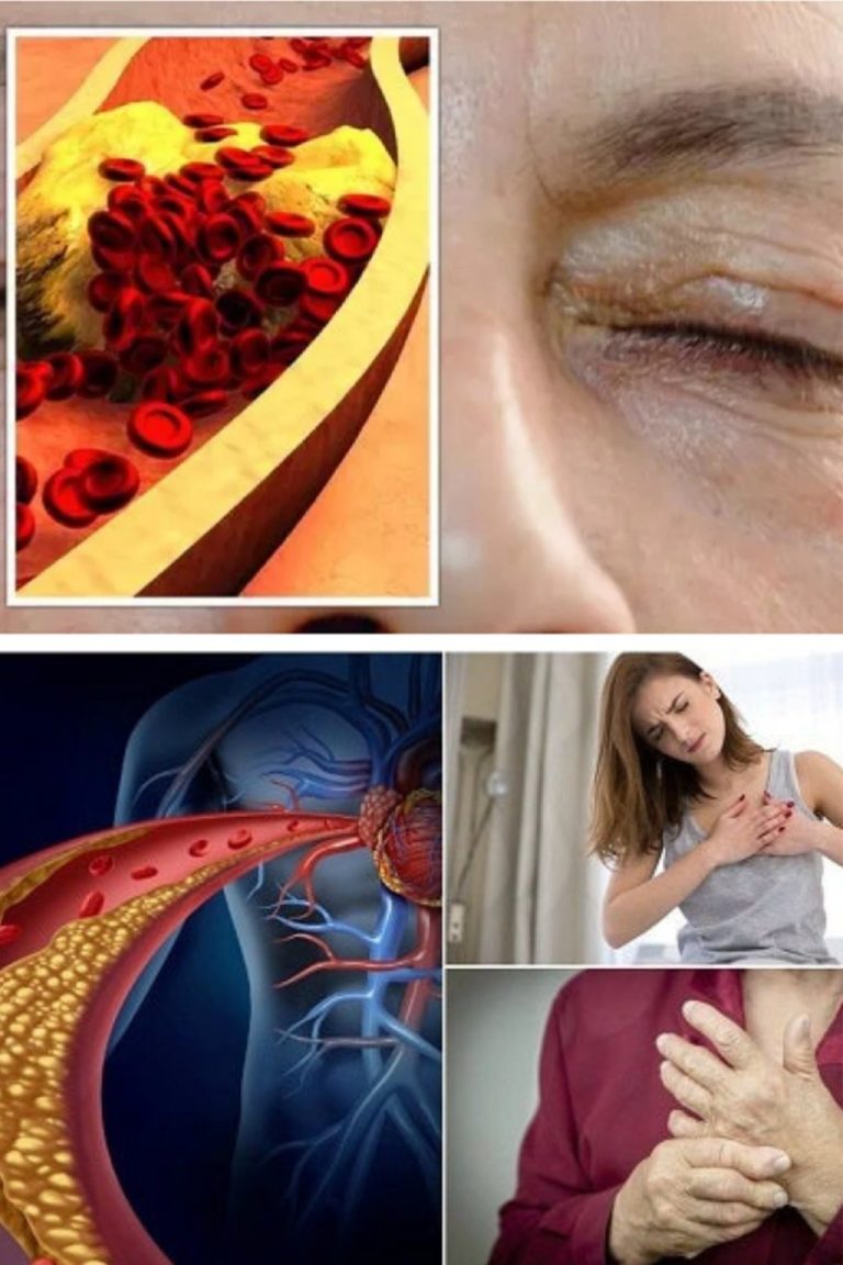 10 objawów wysokiego poziomu cholesterolu: sygnały alarmowe wysyłane przez organizm