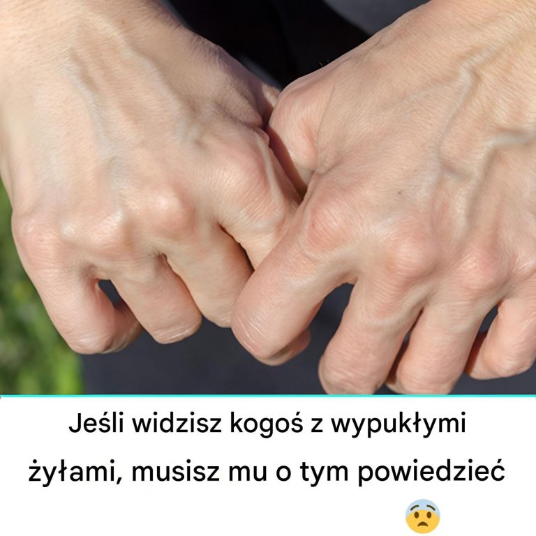 Dlaczego moje żyły nagle stały się widoczne i nabrzmiałe?