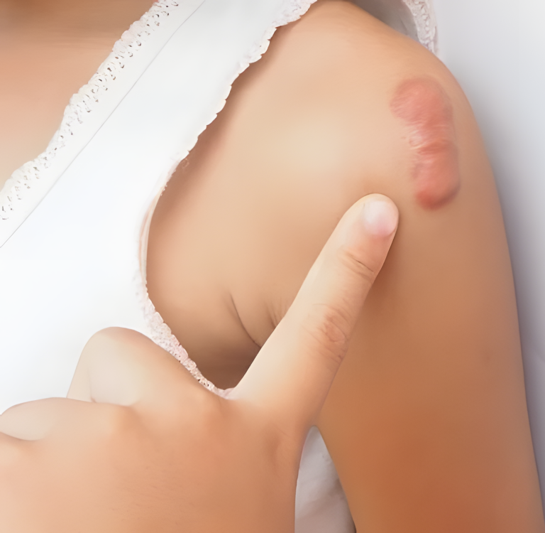 Blizny keloidowe: Jak reagować na pojawienie się tych plam