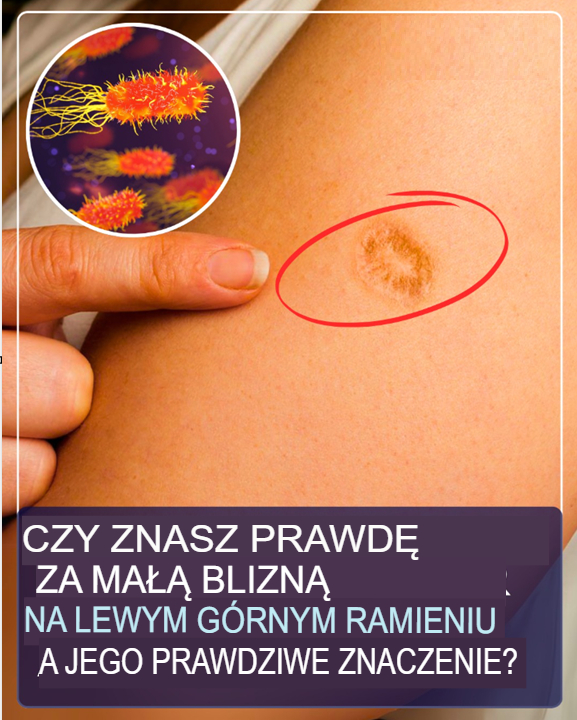 Czy znasz prawdę o małej bliznie na lewym ramieniu i jej prawdziwym znaczeniu?