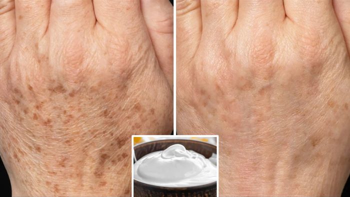 Odśwież swoje dłonie i zredukuj niedoskonałości dzięki tej maseczce z białka jaja