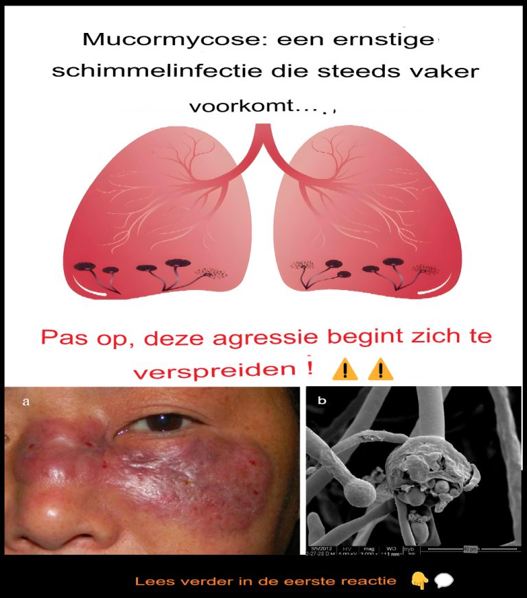 Mukormykoza: poważna infekcja grzybicza, która staje się coraz powszechniejsza
