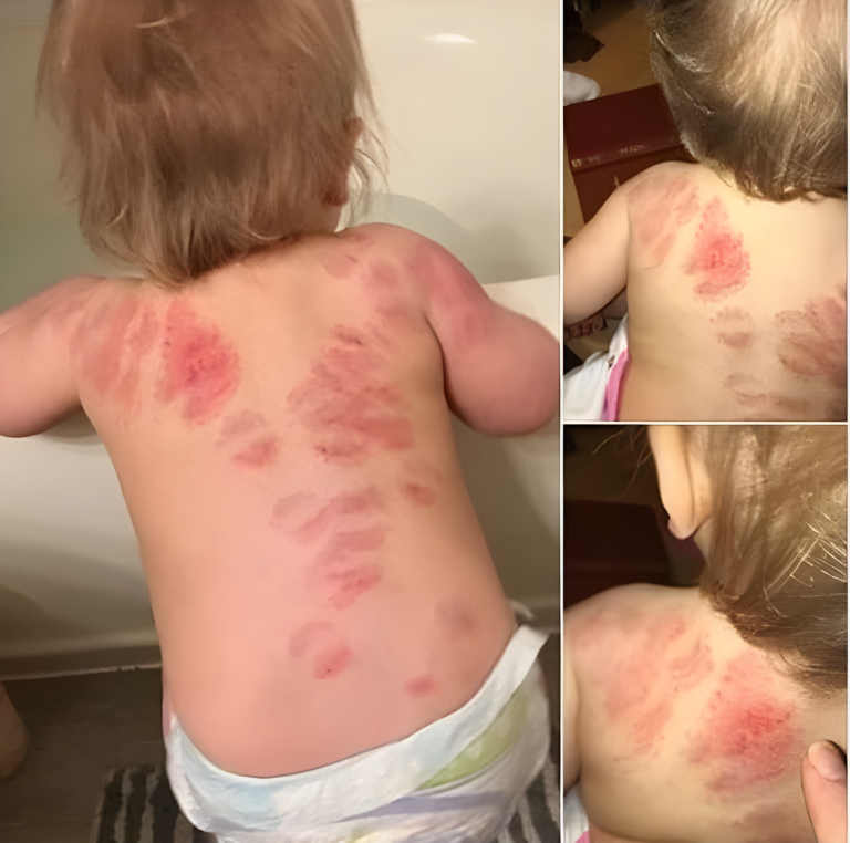 Matka mówi, że jej córka została ugryziona 25 razy w żłobku