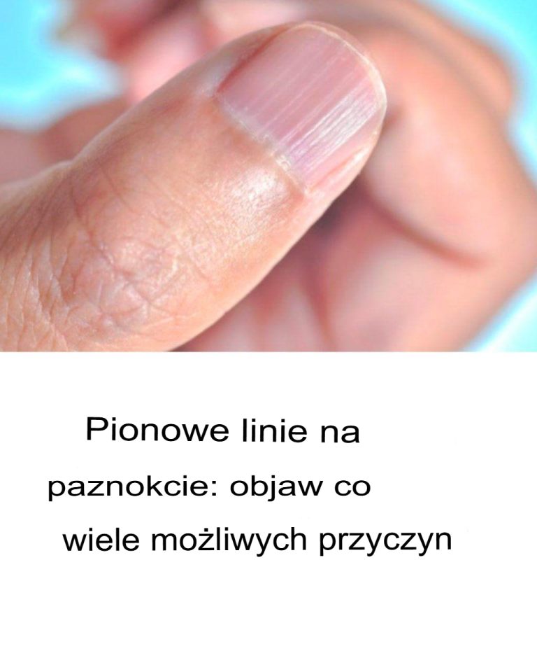 Pionowe linie na paznokciach: objaw o wielu możliwych przyczynach