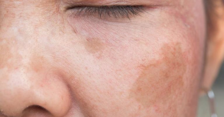 Wystarczy dodać ten prosty składnik do kremu do twarzy, aby pozbyć się niedoskonałości skóry