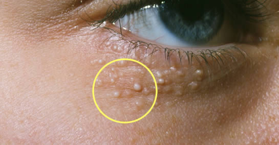 Sposoby na pozbycie się prosaków, czyli irytujących białych grudek na skórze