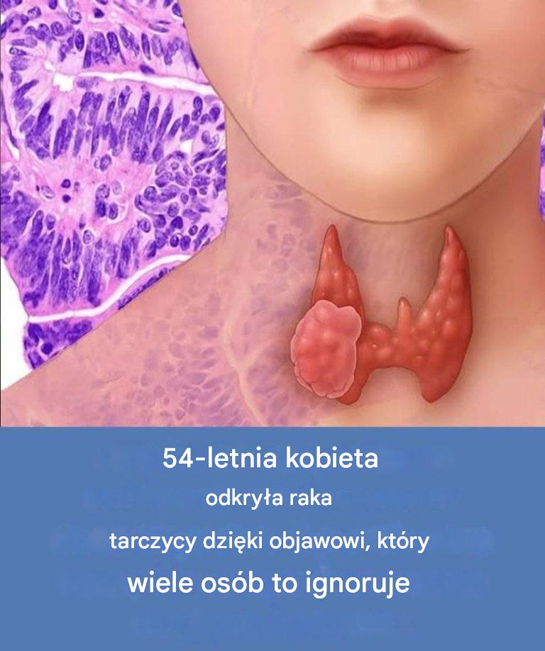 54-letnia kobieta dowiedziała się, że ma raka tarczycy, dzięki objawowi, który często pozostaje niezauważony