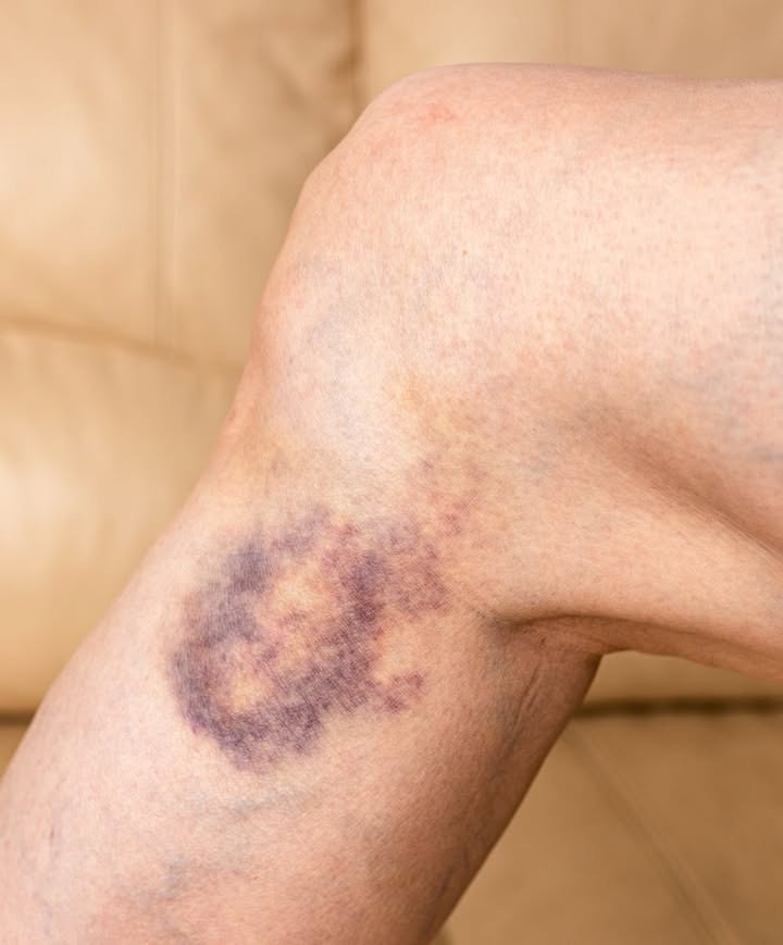 połącz się siniaczę – wszędzie mam fioletowe gry. Het kan niet anders dan lekarz zijn. Czy het heeft een goed keuze zijn?