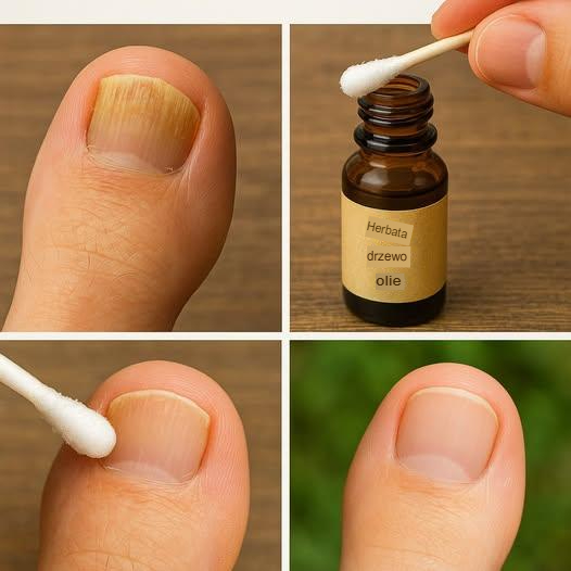 Odkryj cudowne rozwiązanie, które trwale zwalcza grzybicę paznokci!