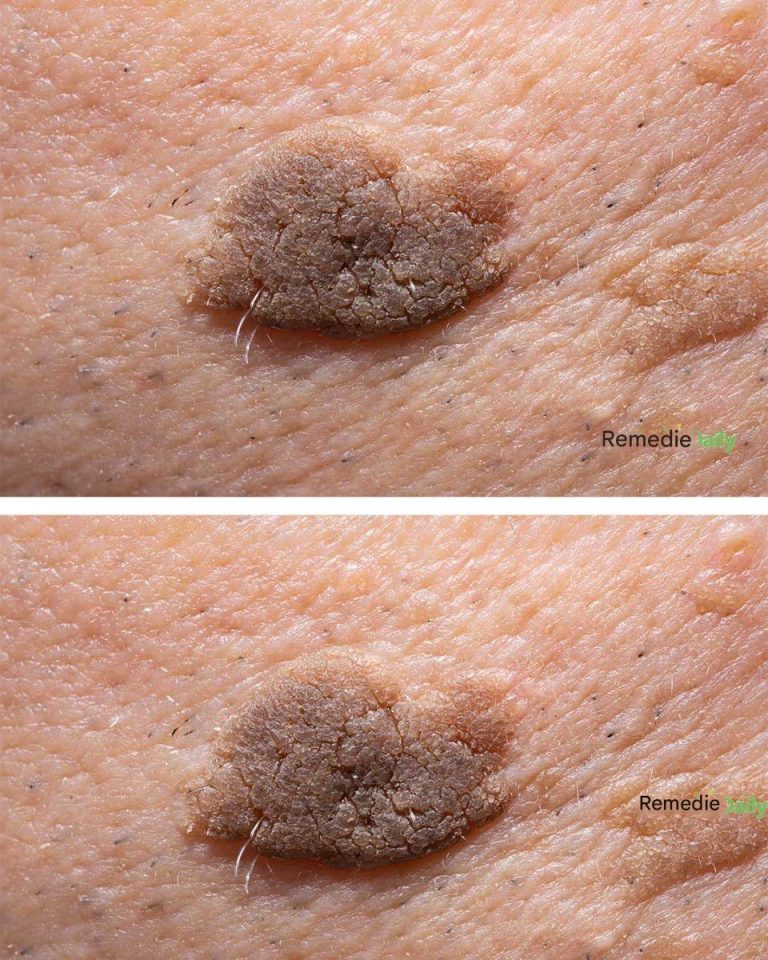 Ten pieprzyk rośnie, ale nie boli. Do wizyty u lekarza jeszcze daleko. Co mam zrobić?