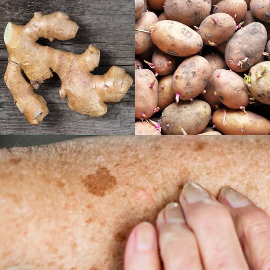 Szokujące, że użyła ziemniaków i imbiru na swoje ciemne plamy – oto, co naprawdę się wydarzyło