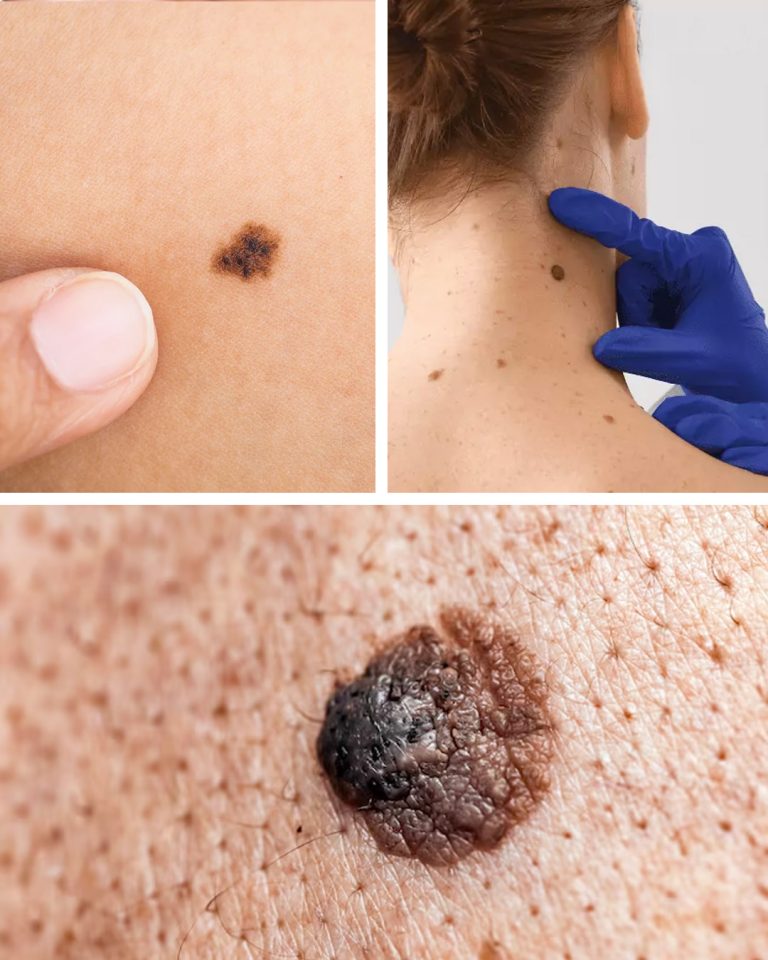 Znamię na skórze: co oznacza?