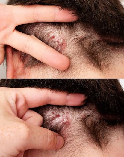 Znalazłam to na skórze głowy mojego syna. Nie mam pojęcia, co to jest i nie możemy szybko umówić się na wizytę u lekarza. Macie jakieś rady?