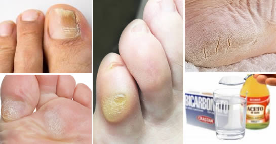 Odciski, modzele i grzybica stóp: jak pozbyć się ich trwale i naturalnie.