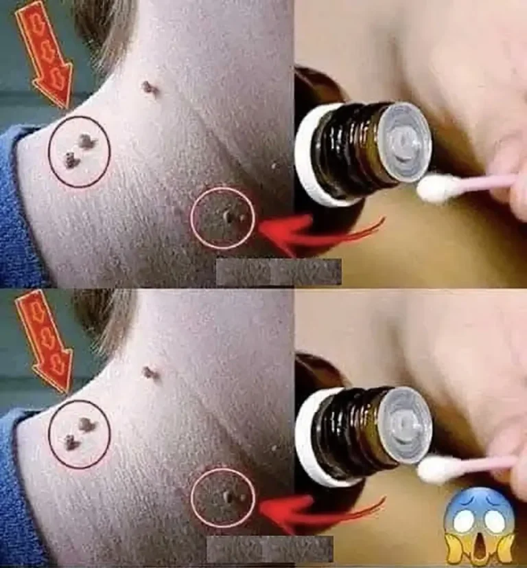 Jak usunąć brodawkę?