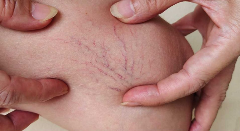 Te czerwone żyły rozprzestrzeniają się po moich udach. Wizyta u lekarza jeszcze daleka. Co mogę zrobić w międzyczasie?