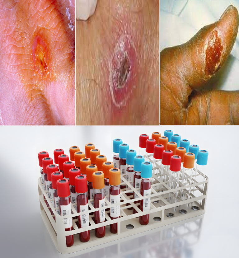 Tularemia❗: Nowa choroba zakaźna. Typowe objawy tularemii: