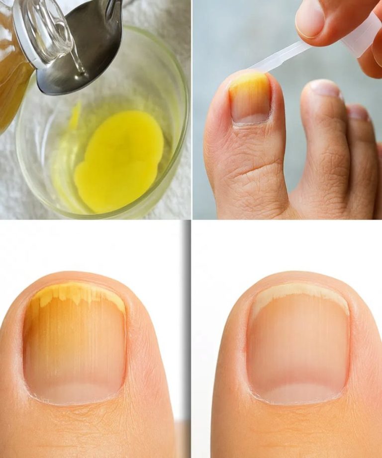 Sprawdzone ludowe sposoby leczenia grzybicy paznokci