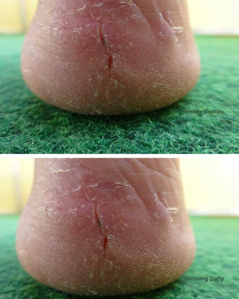 Moje pięty pękają – żaden balsam nie pomaga. Co jeszcze mogę zrobić? Czy powinnam pójść do lekarza?