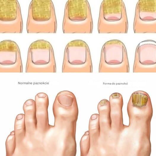 Jak szybko i naturalnie pozbyć się grzybicy paznokci?