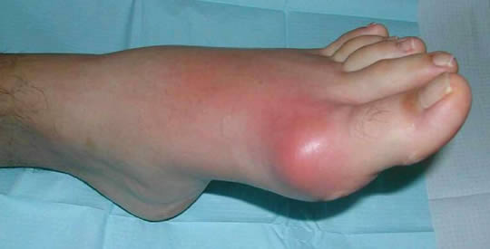 Jak pozbyć się kwasu moczowego ze stawów