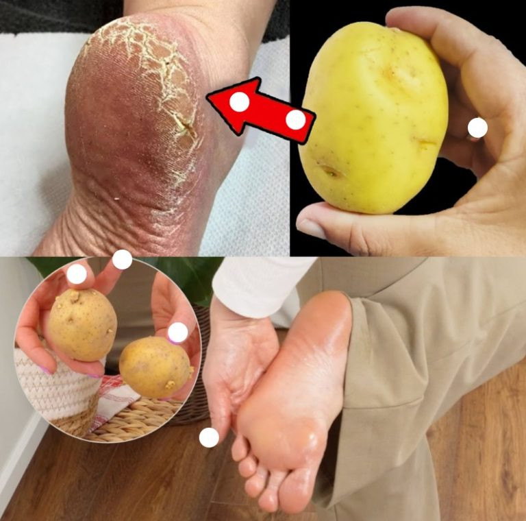 Umarłabym nie wiedząc: Pozbądź się popękanych pięt i uzyskaj gładkie, białe stopy – dzięki ziemniakowi!