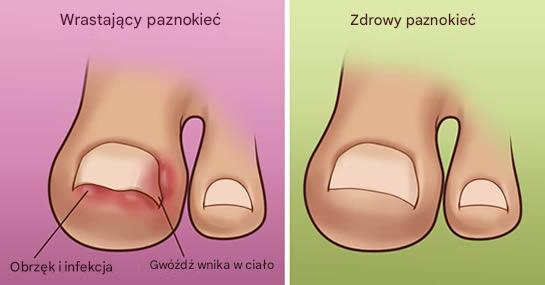Wrastające paznokcie u stóp: Jak szybko i naturalnie sobie z nimi poradzić w domu