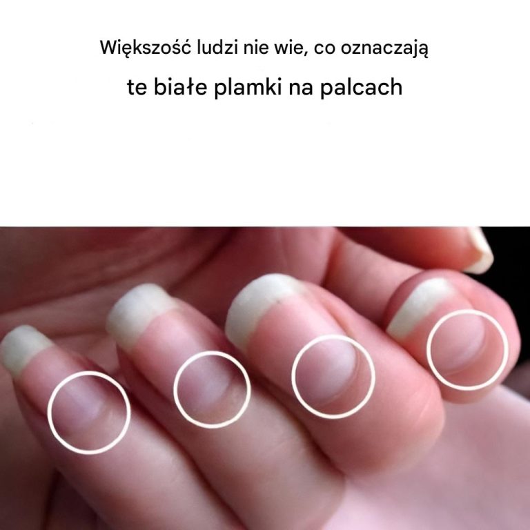 Co oznaczają białe plamki na paznokciach?